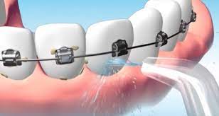 Brackets2 1 - How to Use a Dental Irrigator with Braces: 5 Tips for Better Oral Health
